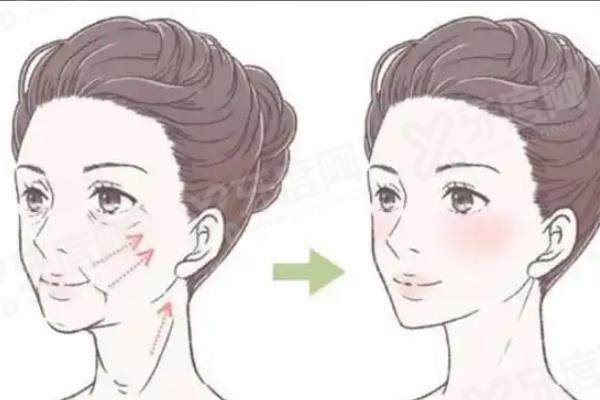 深圳陈洪医生做拉皮怎么样