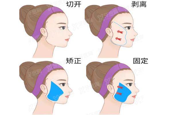 聂云飞拉皮怎么样