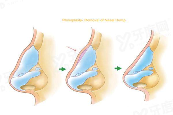广州韩后崔东做鼻修复技术 广州韩后崔东做鼻修复技术