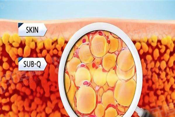 北京赵军舰吸脂怎么样 北京赵军舰吸脂怎么样