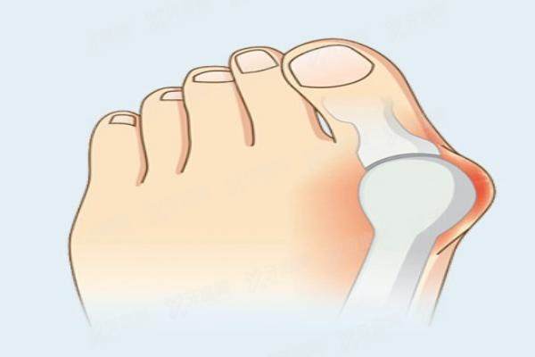 马文足科做大脚骨多少钱 马文足科做大脚骨多少钱