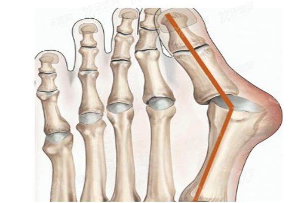 苏敬达拇外翻手术成果好不好 苏敬达拇外翻手术成果好不好