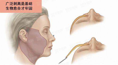 深圳曹孟君医生做富贵包怎么样?治疗富贵包采用土麦森富贵包剥离技术,收费价格7900起!