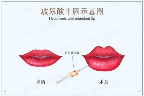南京美莱房志强做鼻子技术怎么样?桥式/小三庭美鼻技术真实自然,价格15800起!