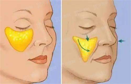 吕瑛医生做双眼皮怎么样？修复双眼皮自然灵动，附收费价格+患者案例