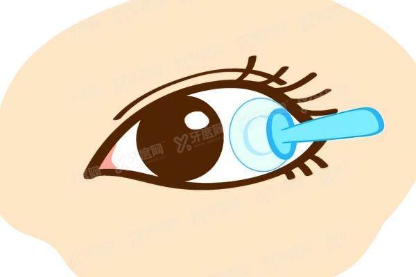 阿尔法角膜塑形镜左右眼颜色.jpg 阿尔法角膜塑形镜左右眼颜色.jpg