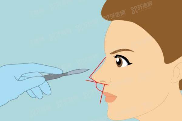 余东文鼻修复手术效果如何?采用四点聚焦均衡术，来看新消息和问诊时间！