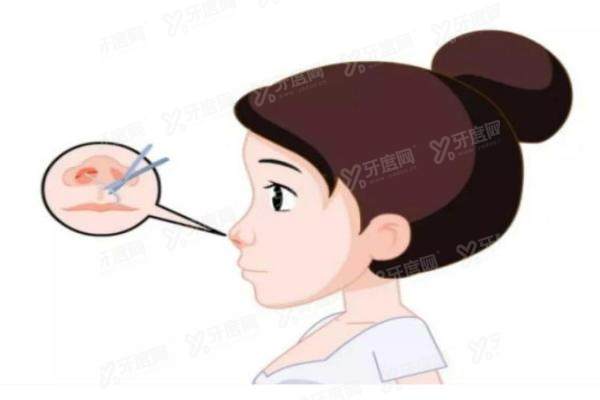 余东文鼻修复.jpg 余东文鼻修复.jpg