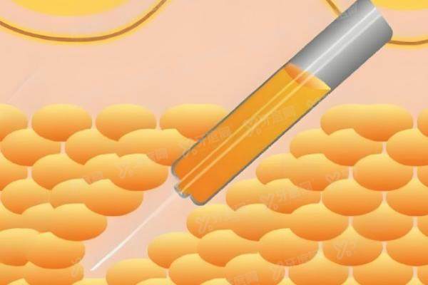 杭州腰腹吸脂医生排名榜 杭州腰腹吸脂医生排名榜