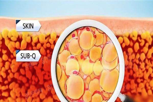 杭州腰腹吸脂医生推荐 杭州腰腹吸脂医生推荐