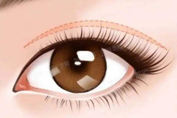 1761726222384254.jpg 双眼皮6.jpg