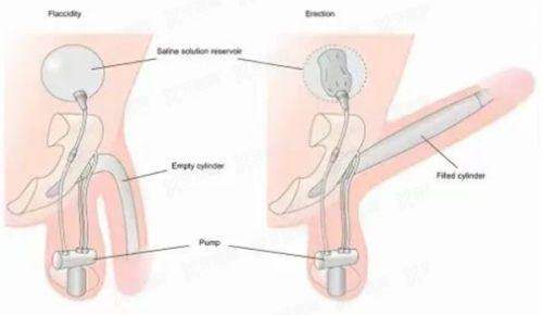 上海陈小剑医生修复双眼皮怎么样？仿生效果好，附坐诊医院+患者案例