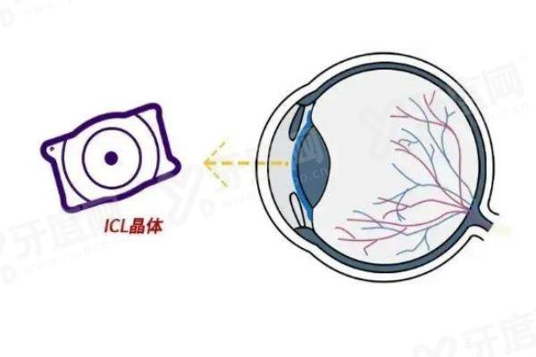 杭州爱尔眼科全飞秒手术医生