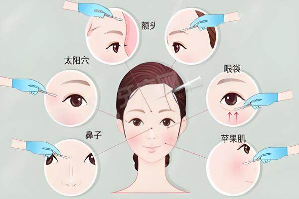 上海王洪医生取脸上注射物收费贵吗技术如何?2025硬核数据全公开