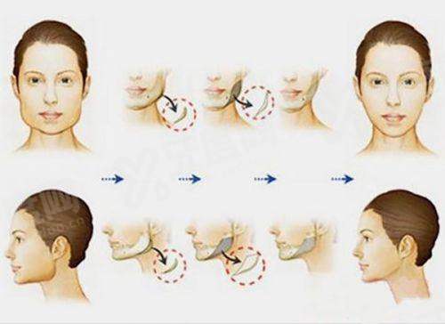 2025取面部异物的正规医院排名榜前十名:含北京/上海/广州/深圳等口碑整形医院