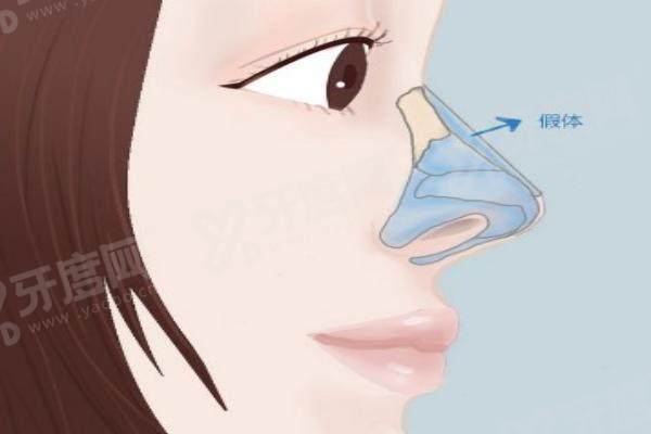 连凯峰隆鼻成果如何 连凯峰隆鼻成果如何