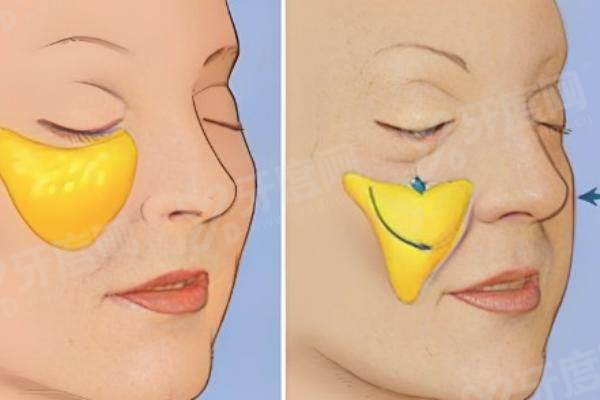 陈凤超做苹果肌复位收费标准 陈凤超做苹果肌复位收费标准