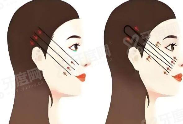 王圣雷医生做拉皮手术实例 王圣雷医生做拉皮手术实例