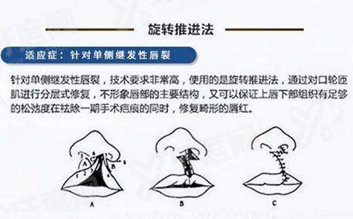 中山大学眼科近视手术收费价格：全飞1.78w元起，地址位于越秀区和天河区