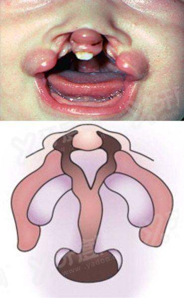 封康医生后巩膜长期效果好口碑佳：术后无视力回退，在北京普祥坐诊！