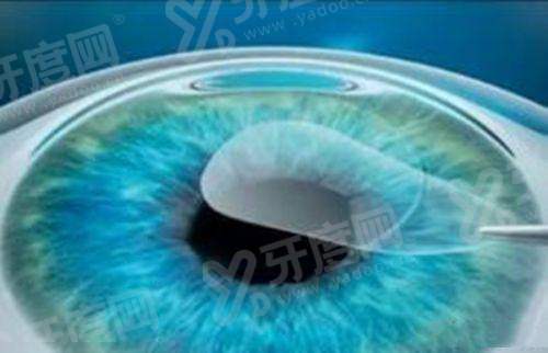 北京同仁眼科做青光眼多少钱？激光虹膜周边切除术5k/小梁切除术8k