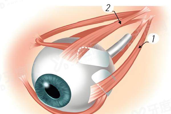 1762420543524975.jpg 后巩膜加固术.jpg