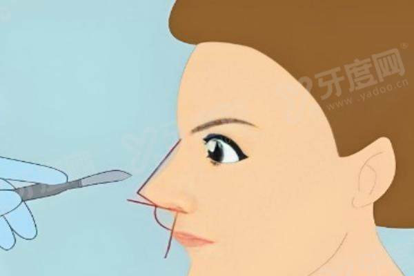 深圳徐荣阳医生做隆鼻多少钱？硅胶隆鼻1.8W+/膨体隆鼻3.8W+/肋软骨鼻综合5.8W+