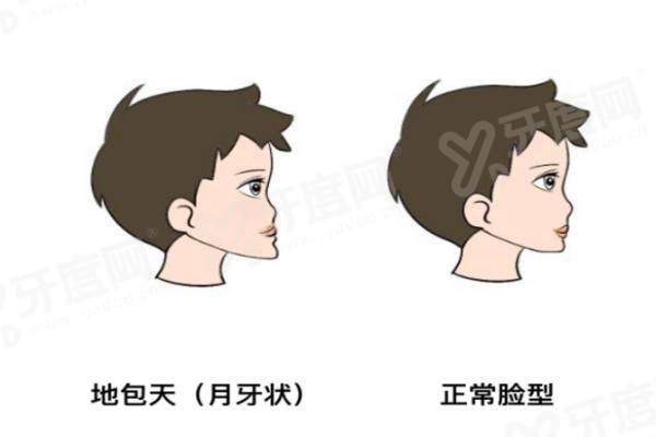 正颌医生王涛现在在哪里坐诊？在重庆松山医院，案例轮廓改善流畅真实