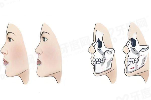 1762508262230710.jpg 正颌1.jpg