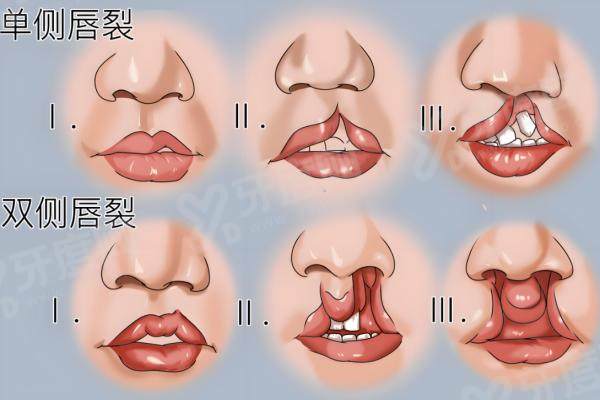 1762508949475327.jpg 唇裂.jpg