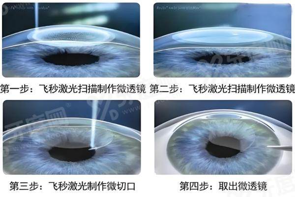 1762754774647064.jpg 全飞秒.jpg