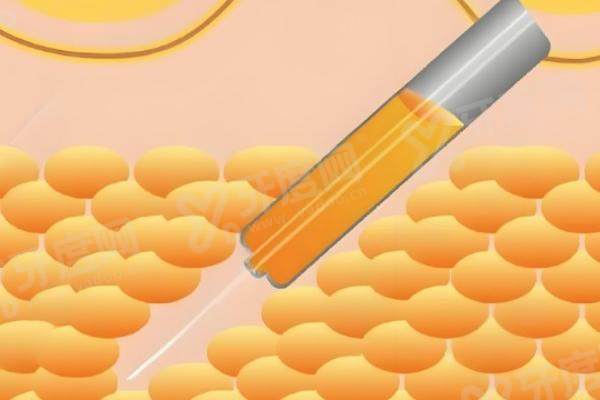 深圳非凡医院做吸脂多少钱?附2025最新价格表+吸脂技术优势