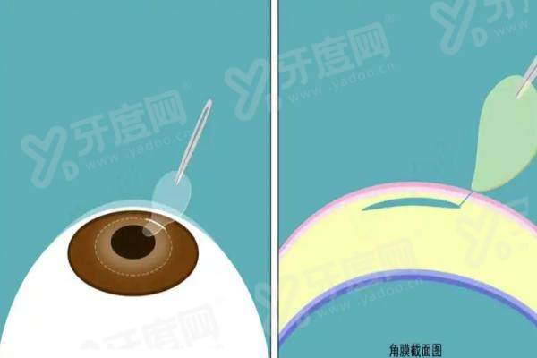 深圳近视眼激光手术哪家医院好？深圳华厦眼科|深圳希玛林顺潮|深圳爱尔眼科等医院排名前三