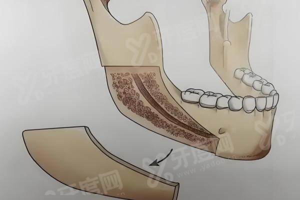 北京黄大勇磨骨真实价格曝光：磨骨三件套10万元起/颧骨颧弓手术3.8万元起，黄大勇磨骨案例效果超惊艳