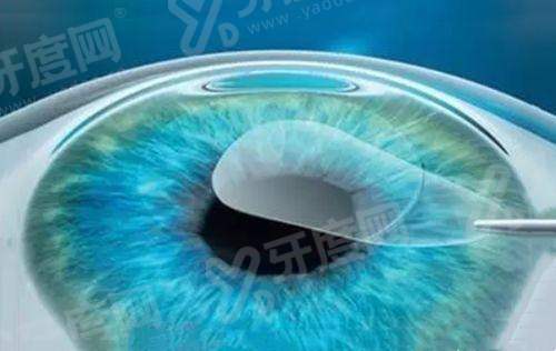 陕西白内障2025报销政策：报销比例+免费白内障定点医院公布！