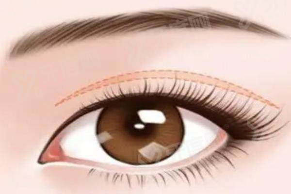 广州余文林唇裂收费标准