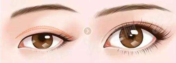 成都李瑞萱双眼皮技术怎么样