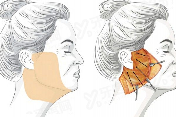 面部减容提升紧致手术多少钱？面部线雕紧致8k+面部提升手术1.5W+