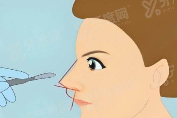 杭州美莱胡斌鼻修复多少钱？鼻梁塌陷修复4万元起/轻度鼻修复4万元起