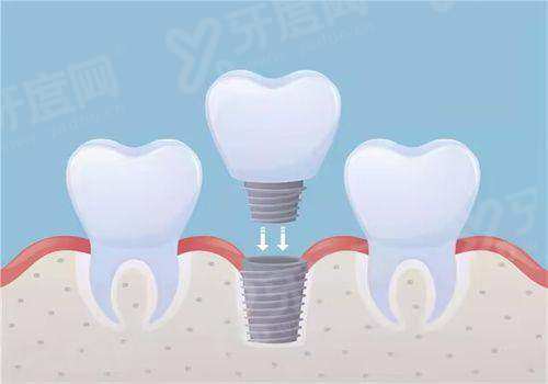 格伦菲尔口腔种植牙没有骗局：种植技术正规靠谱，价格透明无套路1500起一颗