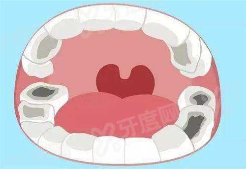 韩国科威尔种植体价格表