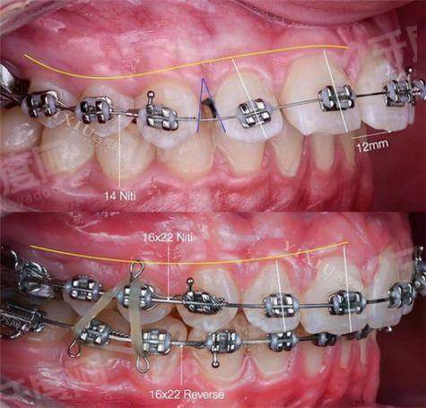 哈雷保持器和比格保持器的区别对比：哈雷有钢丝稳定性好/比格透明美观