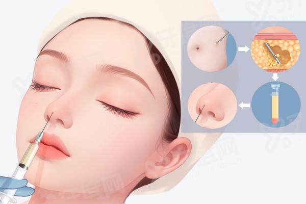 刘彦军鼻综合多少钱？起步7万起！刘彦军做鼻综合修复术后鼻尖可随表情微动绝了！