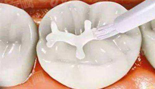 瑞典诺贝尔pmc种植牙怎么样？稳定性好/生物相容性佳/使用寿命长，附价格表