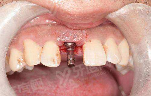 5个种植体品牌介绍及价格表：含德国/瑞士/瑞典/韩国等种植体介绍+适合人群