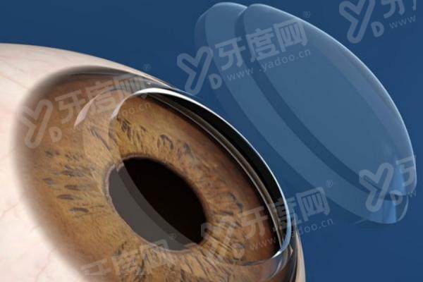 深圳顾宝文医生做icl晶体植入怎么样？专业可靠成效棒附真实案例