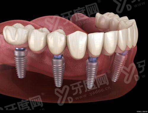 为什么不建议树脂补门牙缝?有变色、磨损，除了树脂补门牙缝还有正畸、瓷贴面等方法