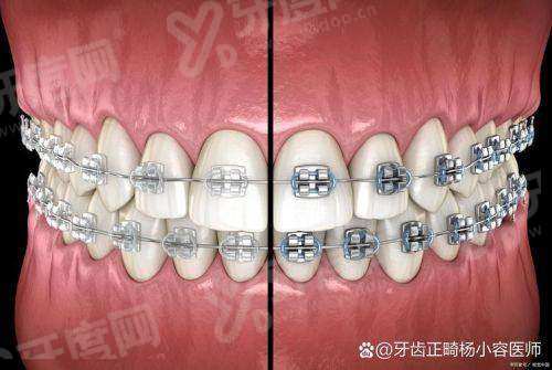 新型无挂钩义齿适合后槽牙吗