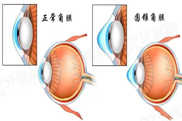 圆锥角膜.jpg