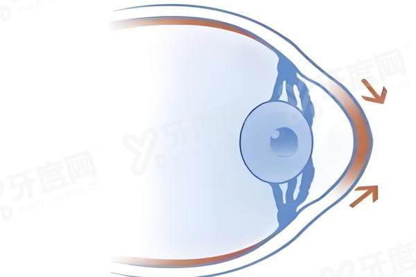 1764140943836357.jpg 圆锥角膜1.jpg